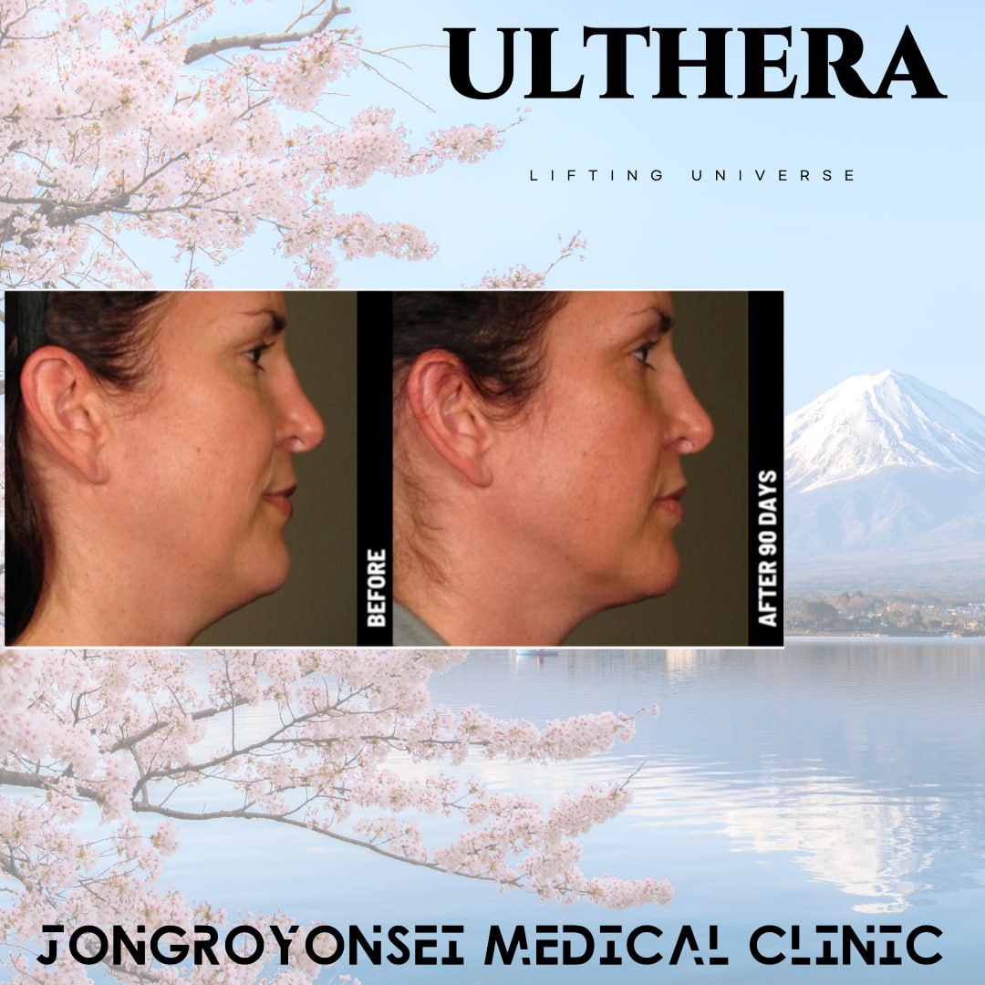 Nâng cơ Ulthera hỗ trợ chăm sóc độ đàn hồi da | Hỗ trợ thay đổi sau 90 ngày | Bệnh viện Jongro Yonsei ga Dongdaemun