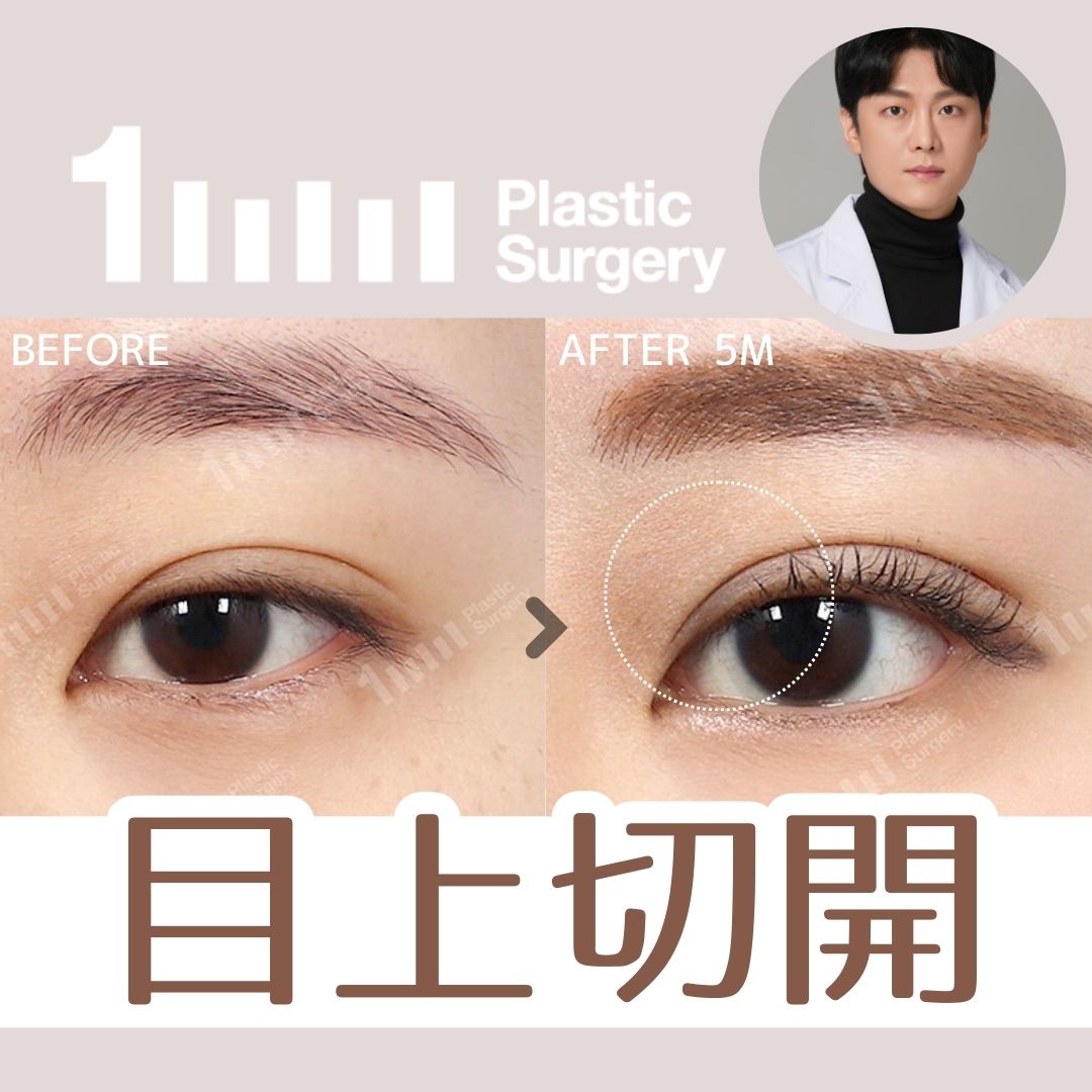 Tạo hình mắt tự nhiên với Cắt trên mắt Custom | 1mm Thẩm mỹ cách ga Gangnam 6 phút đi bộ | Thẩm mỹ Hàn Quốc