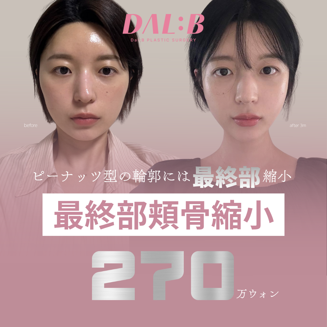 Phẫu thuật thu nhỏ gò má Dalbi Thẩm mỹ Hàn Quốc｜Tạo hình đường viền an toàn với phân tích 3D-CT・Cách ga Sinsa 3 phút đi bộ