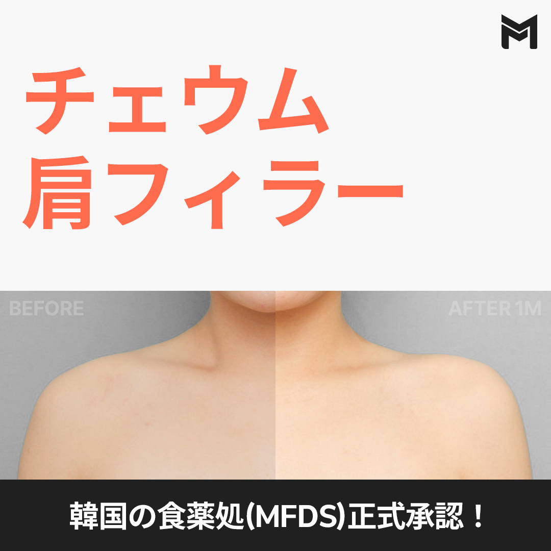 Filler vai Chaeum được Cục Quản lý Thực phẩm và Dược phẩm Hàn Quốc chứng nhận｜Hướng đến vai vuông・hiệu quả mặt nhỏ｜Phòng khám May Fill Gangnam