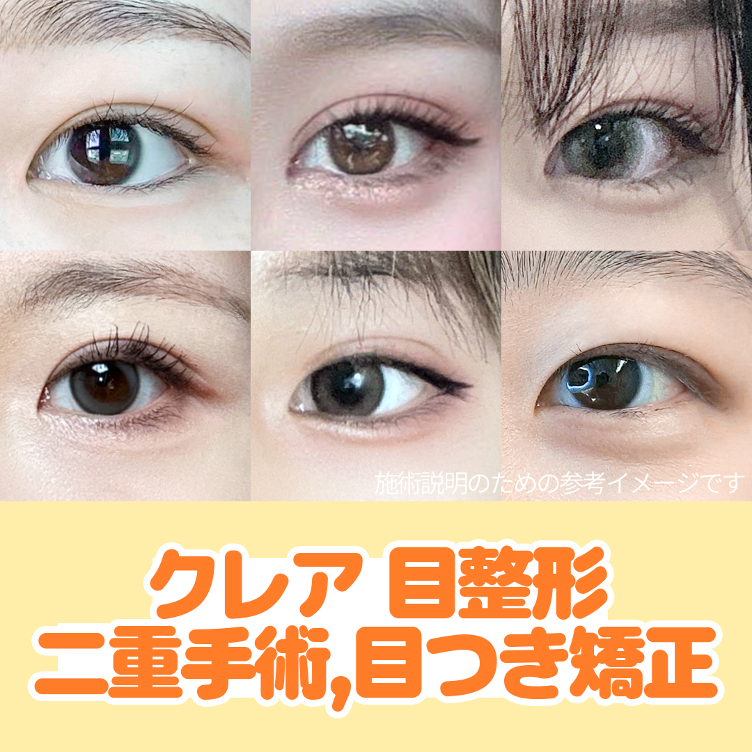 Chỉnh hình mí đôi・Chỉnh ánh mắt Hàn Quốc｜Chỉnh hình mắt đặt hàng từ 530.000 won｜Claire Thẩm mỹ (Trước ga Gangnam)