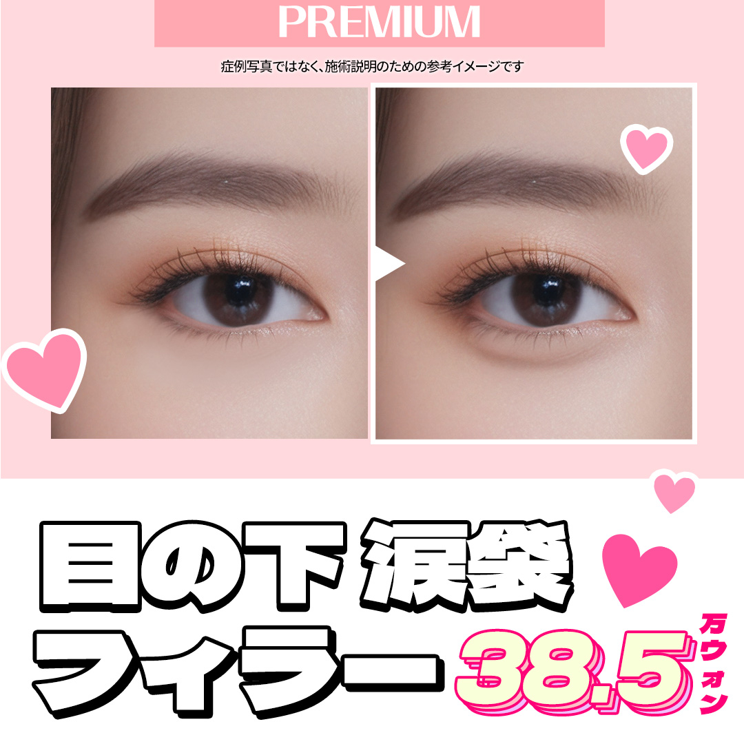 Filler túi lệ hướng đến vùng mắt trẻ thơ tự nhiên｜Sử dụng kim cannula giảm đau｜Seoul Hongik Univ. stn.・Phòng khám Jfeel Hongdae