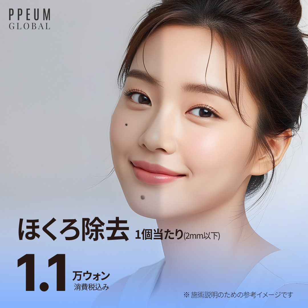 Tẩy nốt ruồi tại Myeong-dong Hàn Quốc | Điều trị laser từ khoảng 1.191 yên cho 1 nốt dưới 2mm