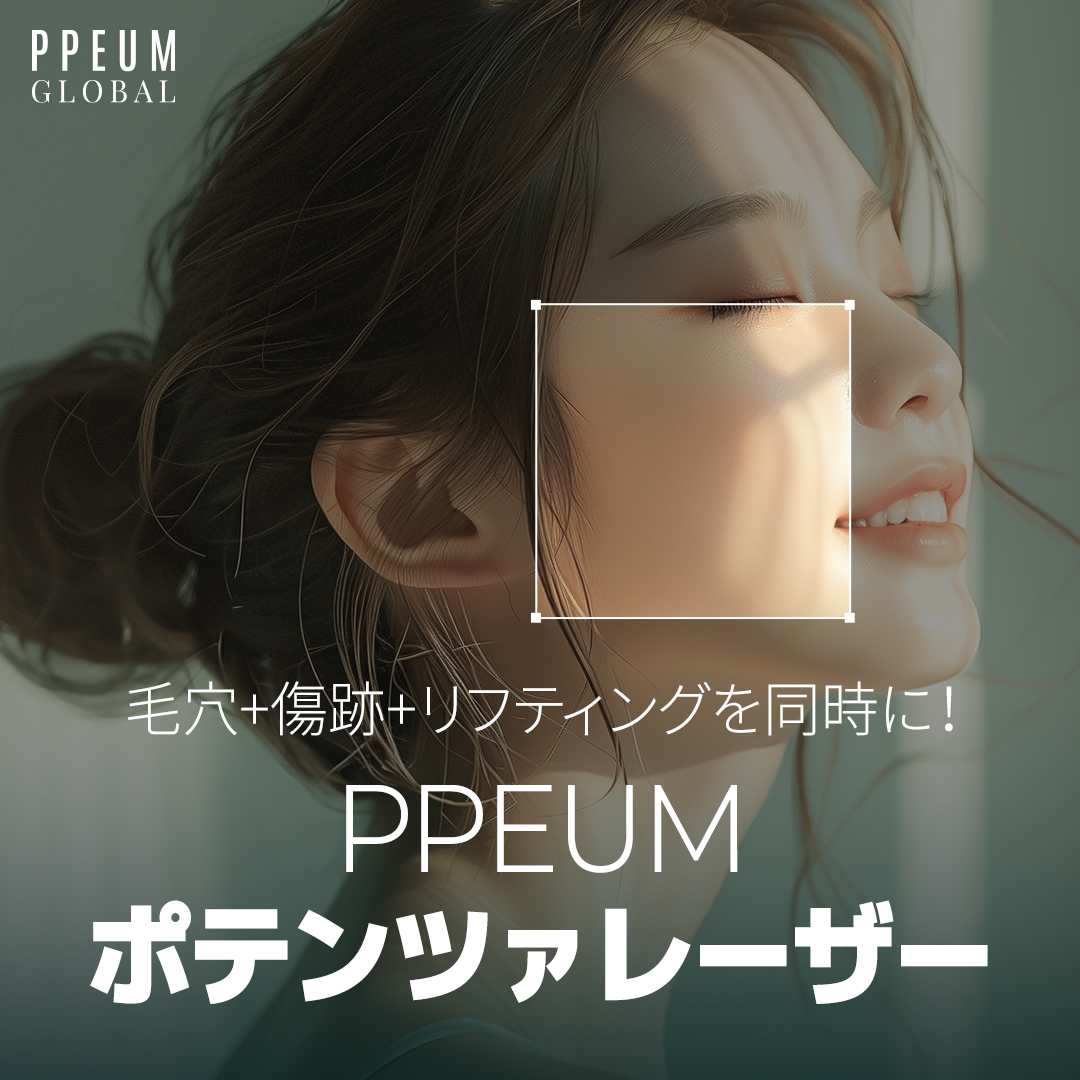 Potenza Laser PPEUM | Kim siêu nhỏ × RF sóng cao tần chăm sóc lỗ chân lông, sẹo, nâng cơ