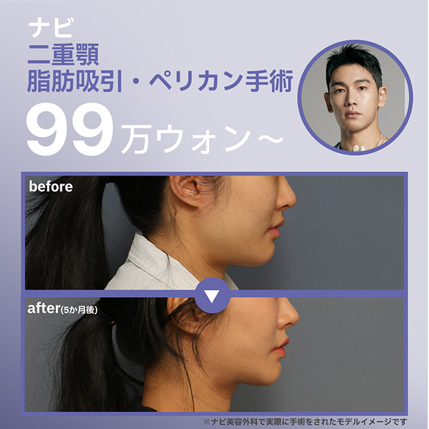Hút mỡ cằm đôi・Phẫu thuật Pelican tạo đường viền mặt sắc nét｜Navi Plastic Surgery (Seoul Nonhyeon)