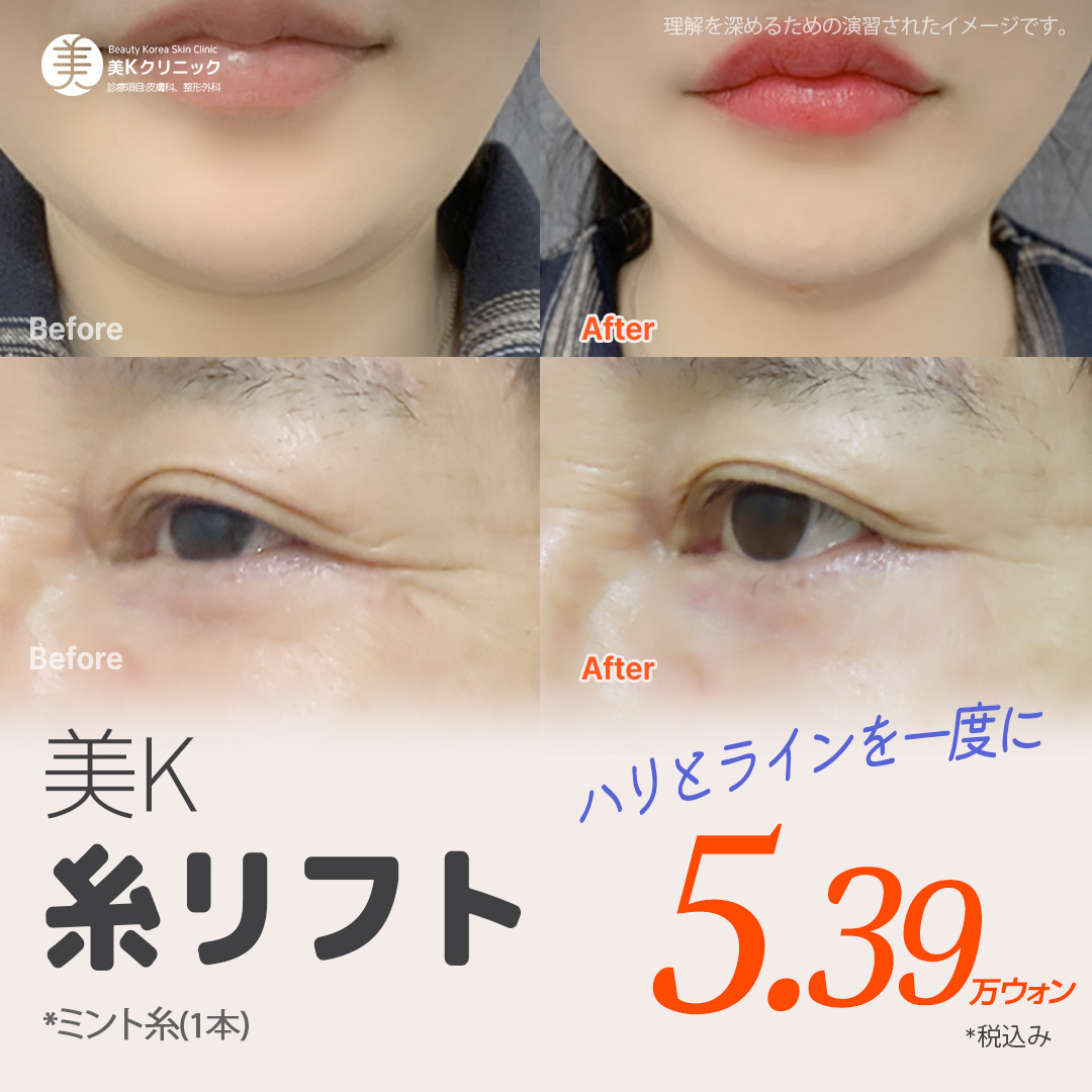 Chỉ nâng tại Phòng khám Mi K ga Gangnam | Chỉ Mint cải thiện rãnh mũi má và chảy xệ | Từ 5,835 Yên