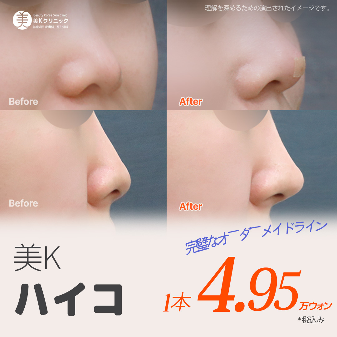 Nâng mũi bằng chỉ Mint Hiko | Tạo dáng mũi tự nhiên không cần phẫu thuật | Phòng khám Mi K ga Gangnam