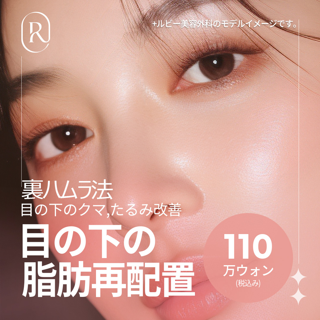 Phương pháp Hamra trong (Tái phân bổ mỡ dưới mắt) hướng đến cải thiện quầng thâm và chảy xệ | Seoul Sinsa stn. - Ruby Thẩm mỹ Ngoại khoa