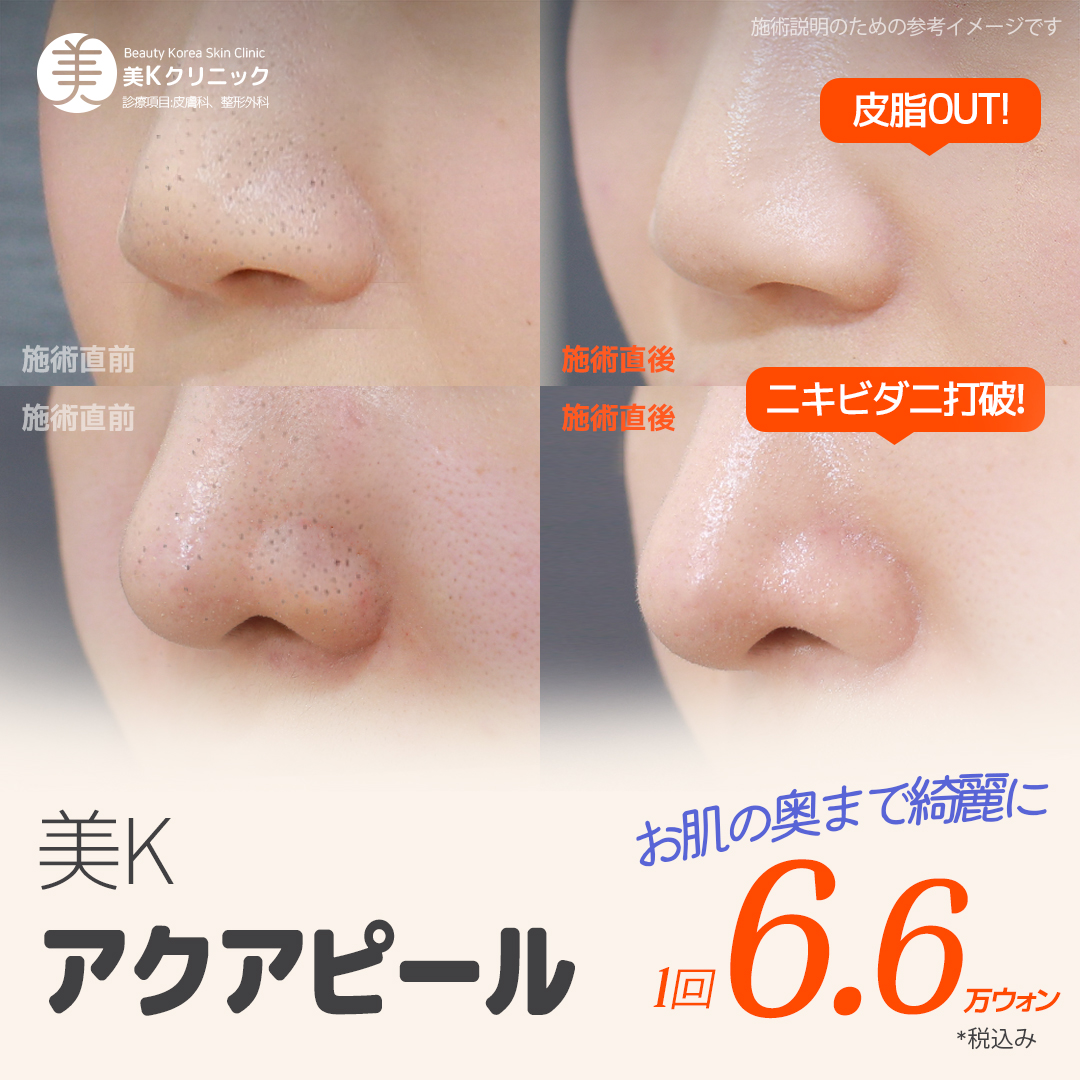 Chăm sóc lỗ chân lông Aqua Peel | Loại bỏ tế bào chết, bã nhờn, demodex theo 3 bước | Phòng khám MiK (kết nối trực tiếp ga Gangnam)