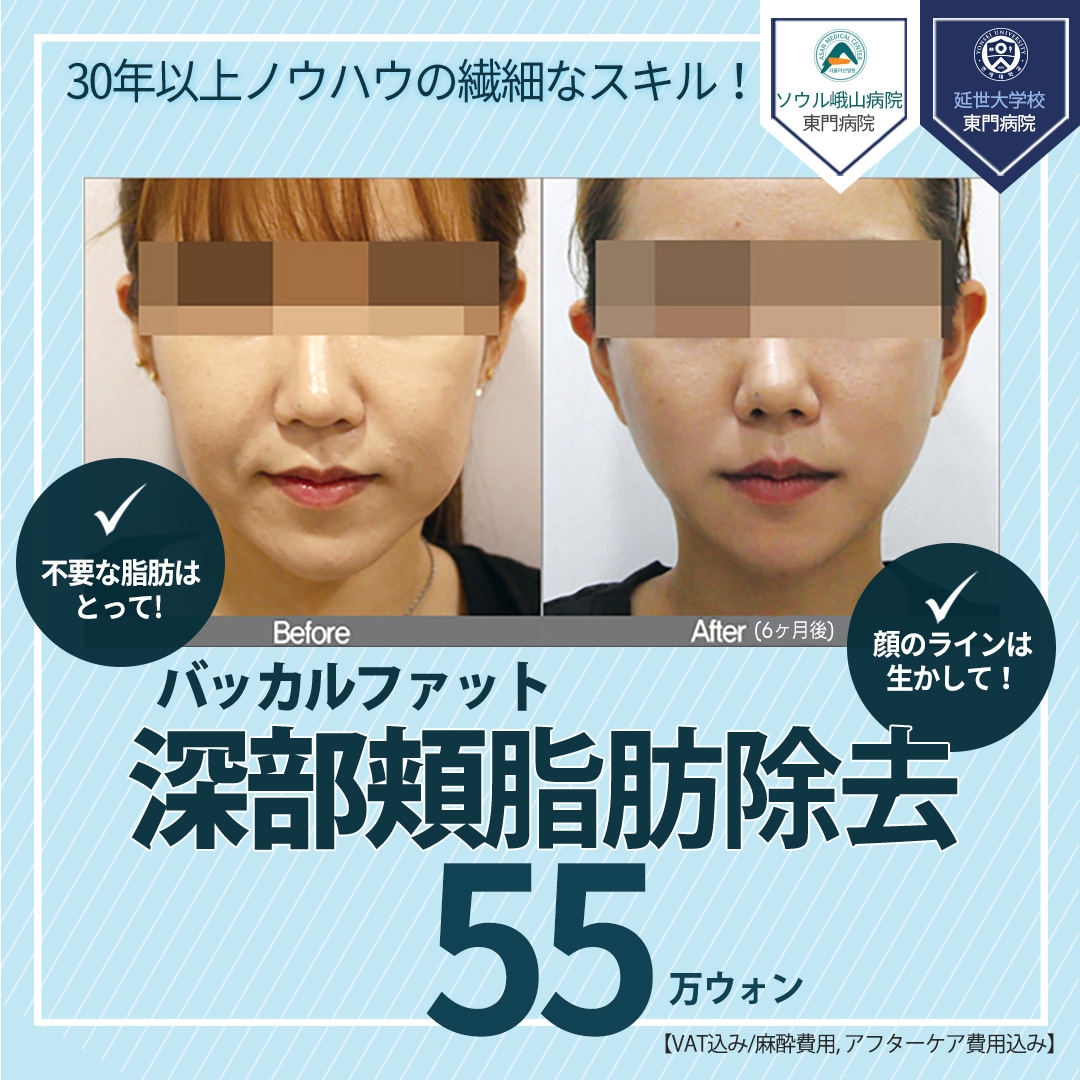 Loại bỏ mỡ Buccal (mỡ má sâu) tạo mặt nhỏ | Hơn 30 năm kinh nghiệm | Thẩm mỹ viện Jerim ngay ga Apgujeong