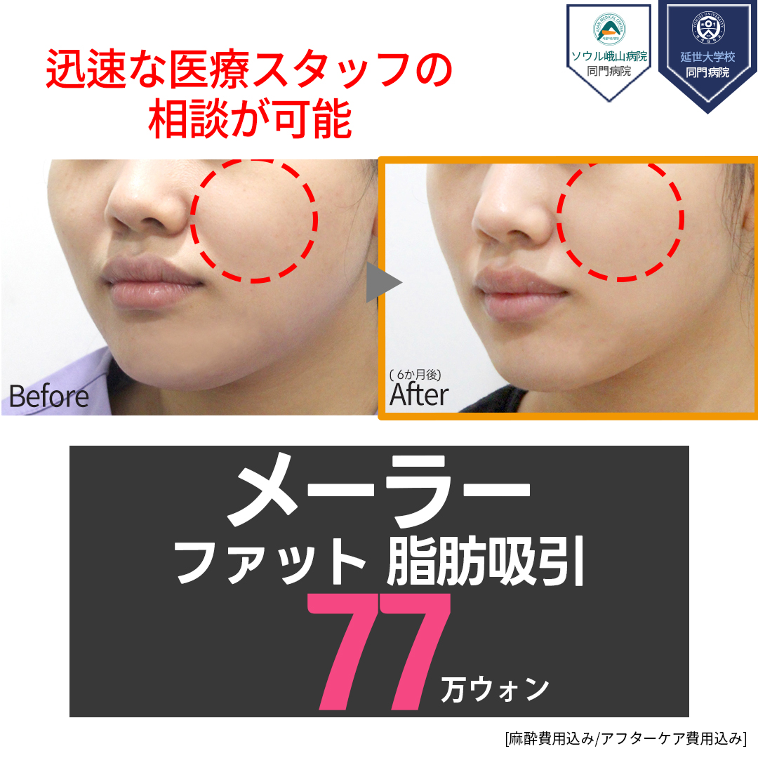 Hút mỡ Malar Fat tạo đường viền mặt trẻ | Thẩm mỹ viện Jerim Seoul Apgujeong | Điều trị 30 phút