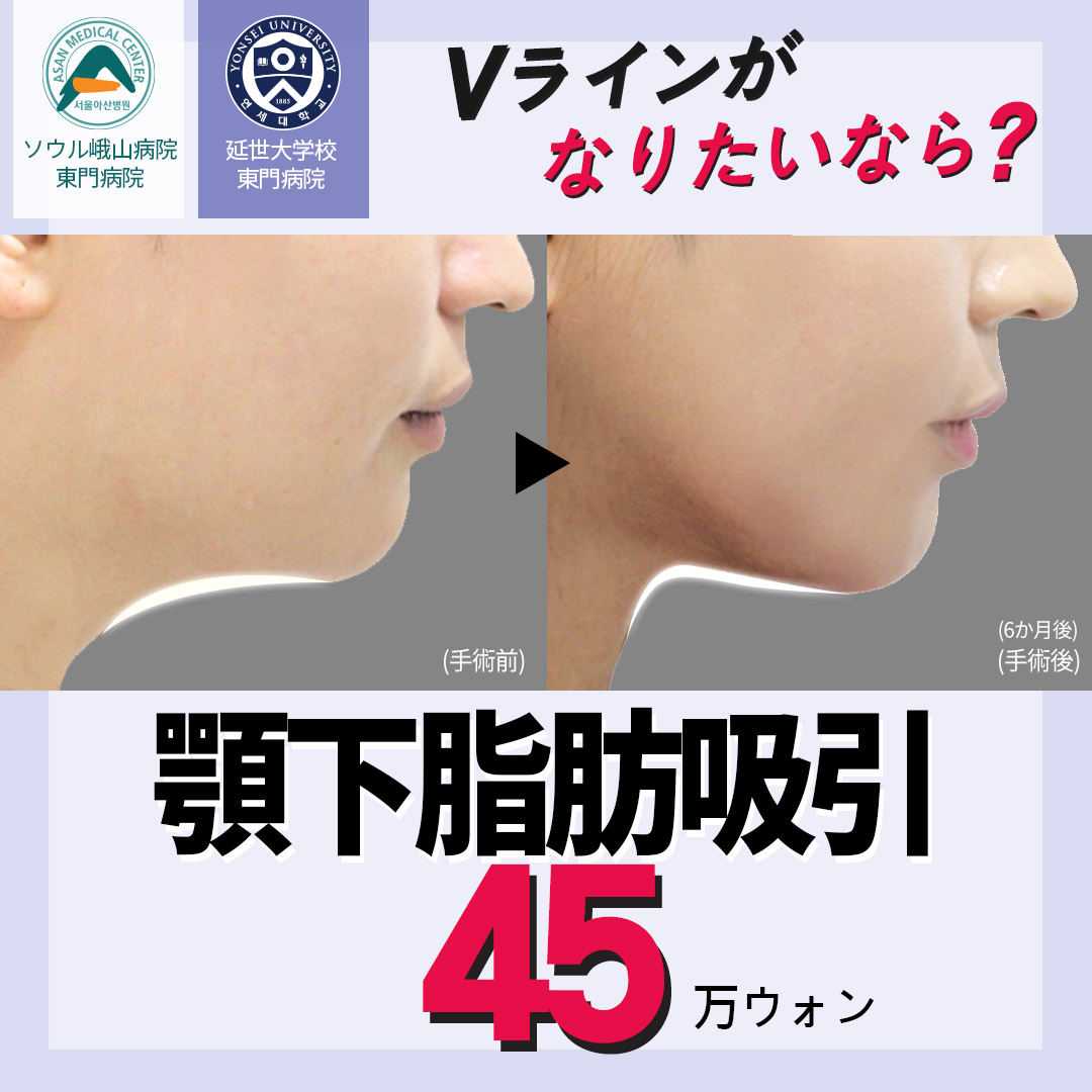 Hút mỡ dưới cằm tại Phòng khám Thẩm mỹ Jerim Hàn Quốc hướng đến tạo hình V-line | 30 năm kinh nghiệm trước ga Apgujeong