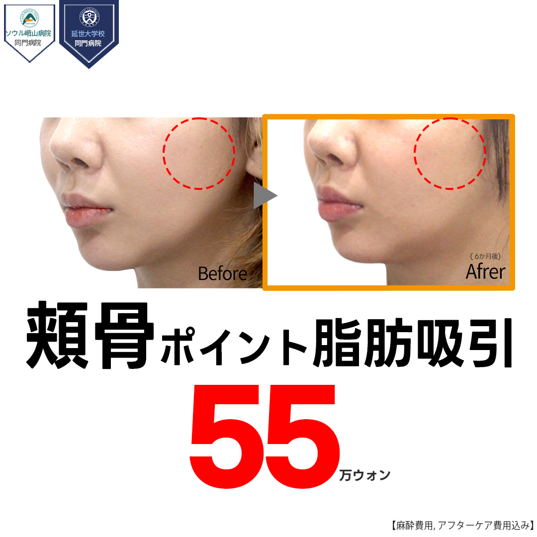 Hút mỡ điểm xương gò má hướng đến mặt nhỏ | Loại bỏ mỡ 3 lớp | Jerim Thẩm mỹ Ngoại khoa | Cách ga Apgujeong 1 phút