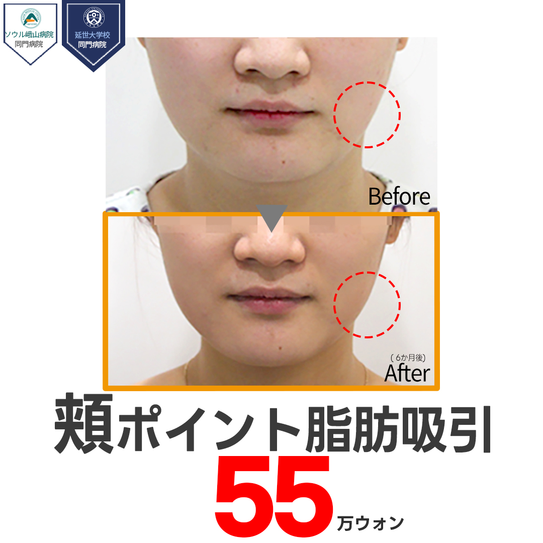 Hút mỡ má Hàn Quốc hướng đến mặt nhỏ | Loại bỏ mỡ 3 lớp chính xác bởi cơ sở y tế liên kết Đại học Yonsei Jerim Thẩm mỹ Ngoại khoa