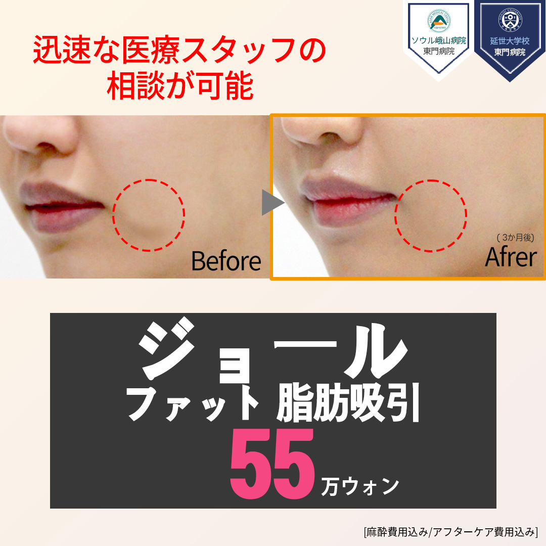 Hút mỡ Jowl Fat hướng tới mặt nhỏ | Liệu trình 20 phút, sinh hoạt hàng ngày từ hôm sau | Seoul Apgujeong Jerim Thẩm mỹ Ngoại khoa