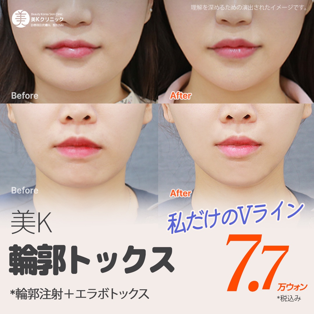 V-line Contour Tox｜Hướng đến gọn mặt bằng Botox hàm + tiêm tan mỡ｜Phòng khám Mikei ga Gangnam Seoul