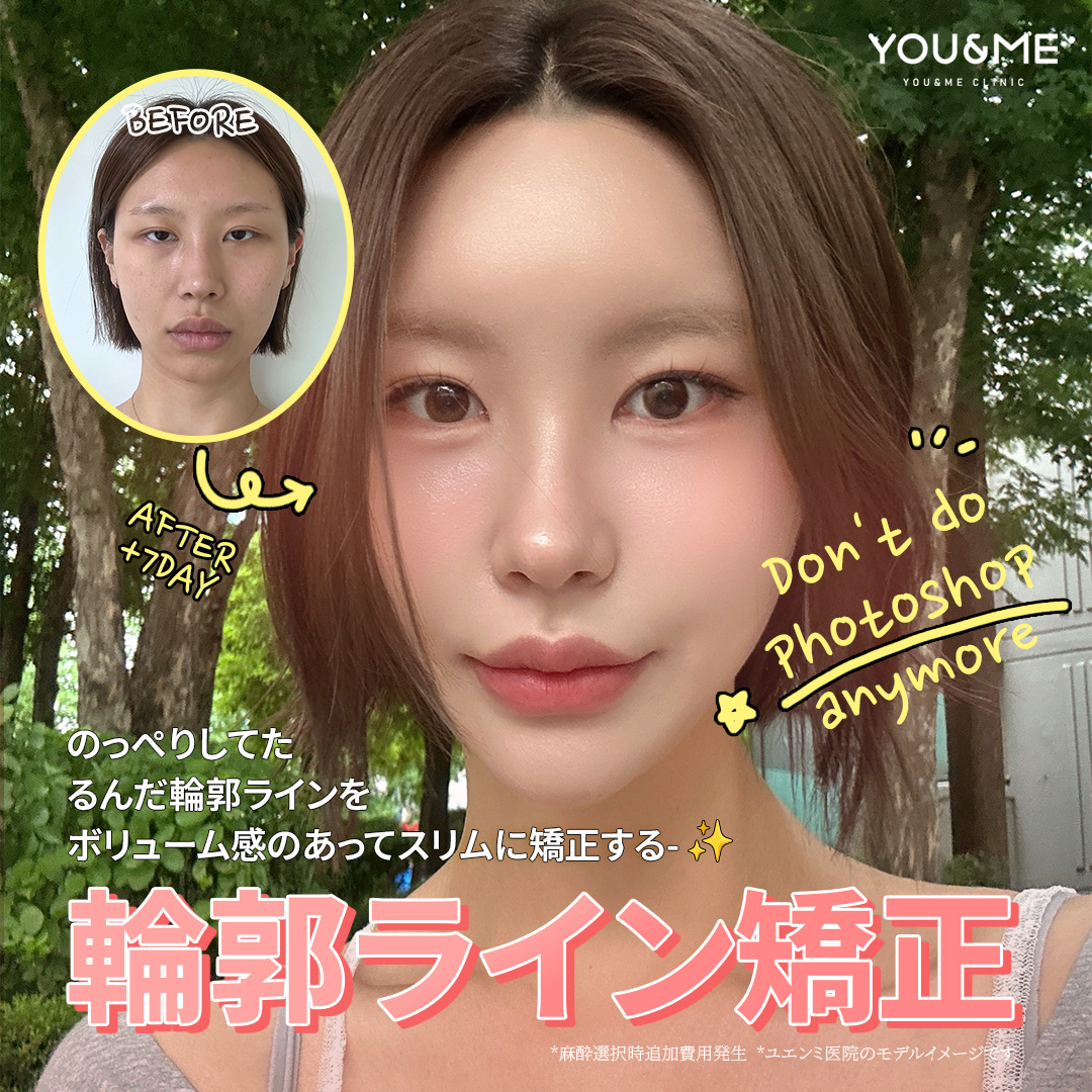 韓国ユエンミ医院の輪郭ライン矯正｜複数の糸リフト技術でたるみ改善を目指すカンナム駅クリニック