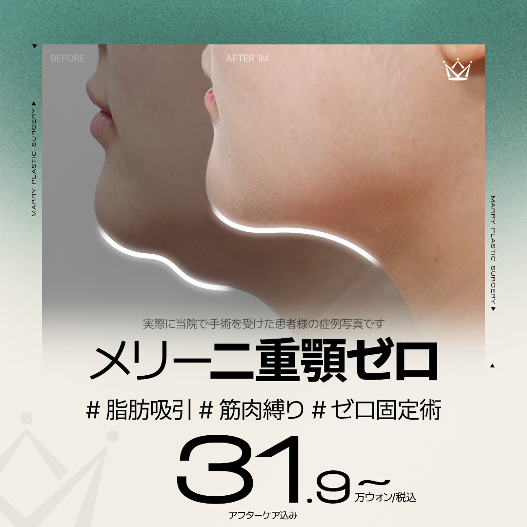 Hút mỡ nọng cằm + buộc cơ + phẫu thuật cố định Zero | Phân tích 3D-CT chính xác tạo V-line | Thẩm mỹ viện Merry Apgujeong