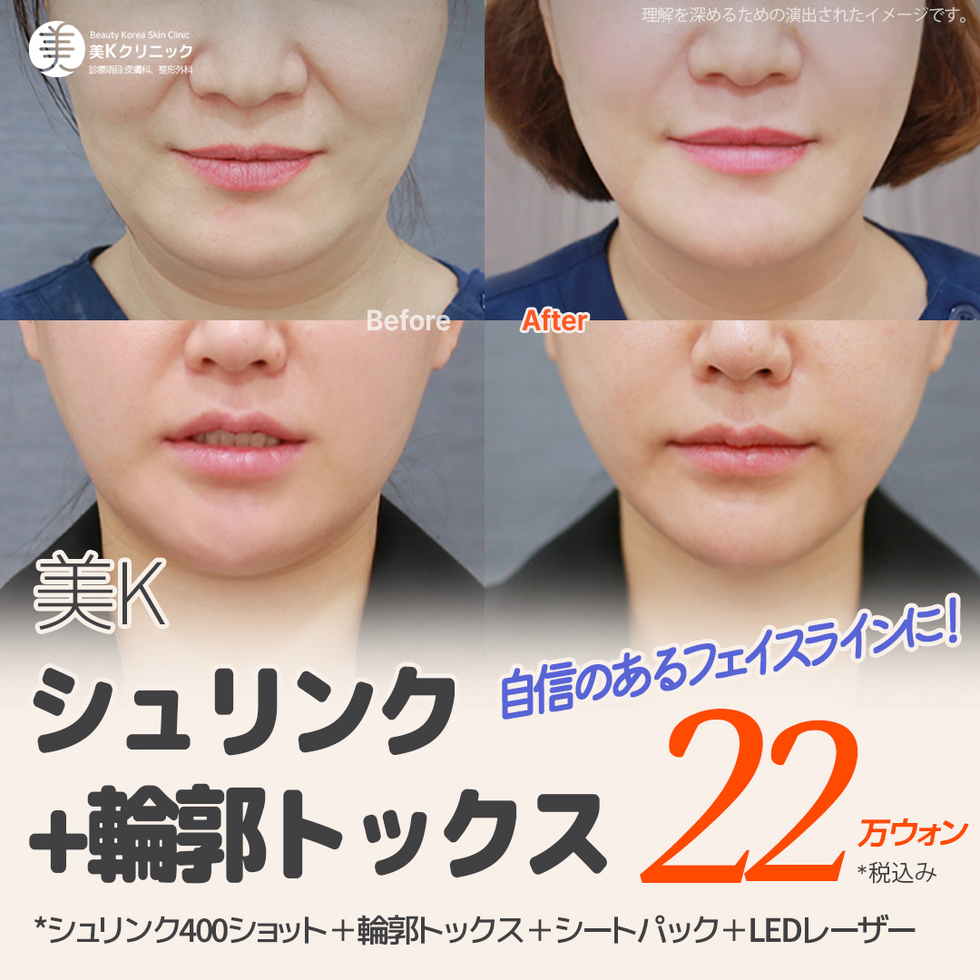 Shrink 400 shot + Contour Tox chăm sóc V-line mặt nhỏ | Phòng khám MiK Seoul ga Gangnam
