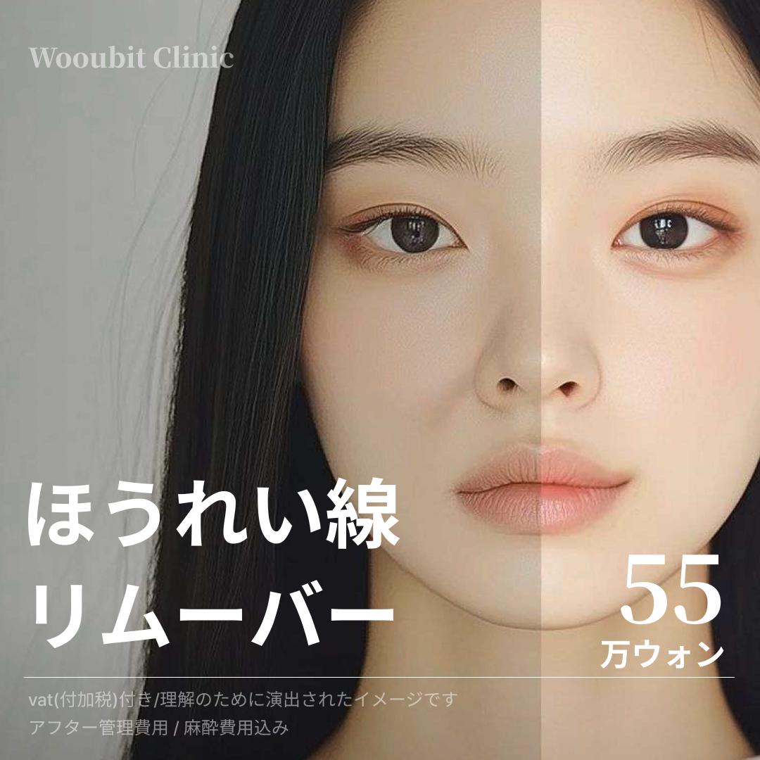 Điều trị kết hợp chỉ + filler chuyên cho rãnh mũi má | Công pháp lưới ngăn di chuyển bền lâu | Wooubit Clinic Sinnonhyeon, Seoul