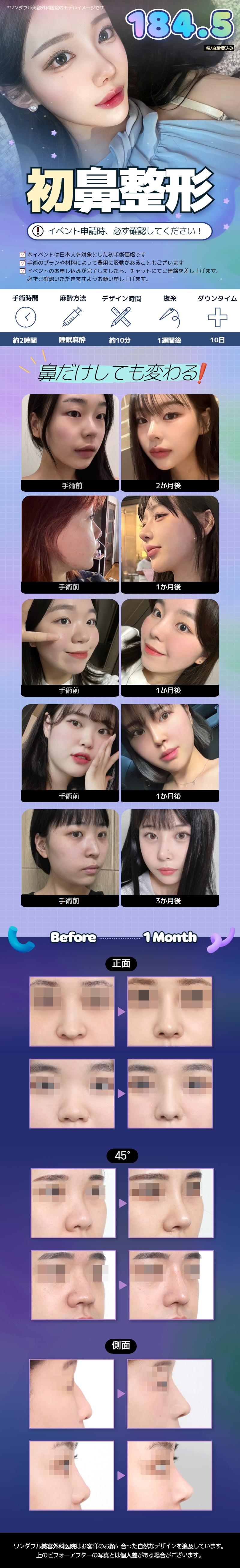 Phẫu thuật mũi Hàn Quốc (Lần đầu) | Wonderful Thẩm mỹ Gangnam theo đuổi thiết kế tự nhiên | Khoảng 200.000 yên bao gồm phí gây mê