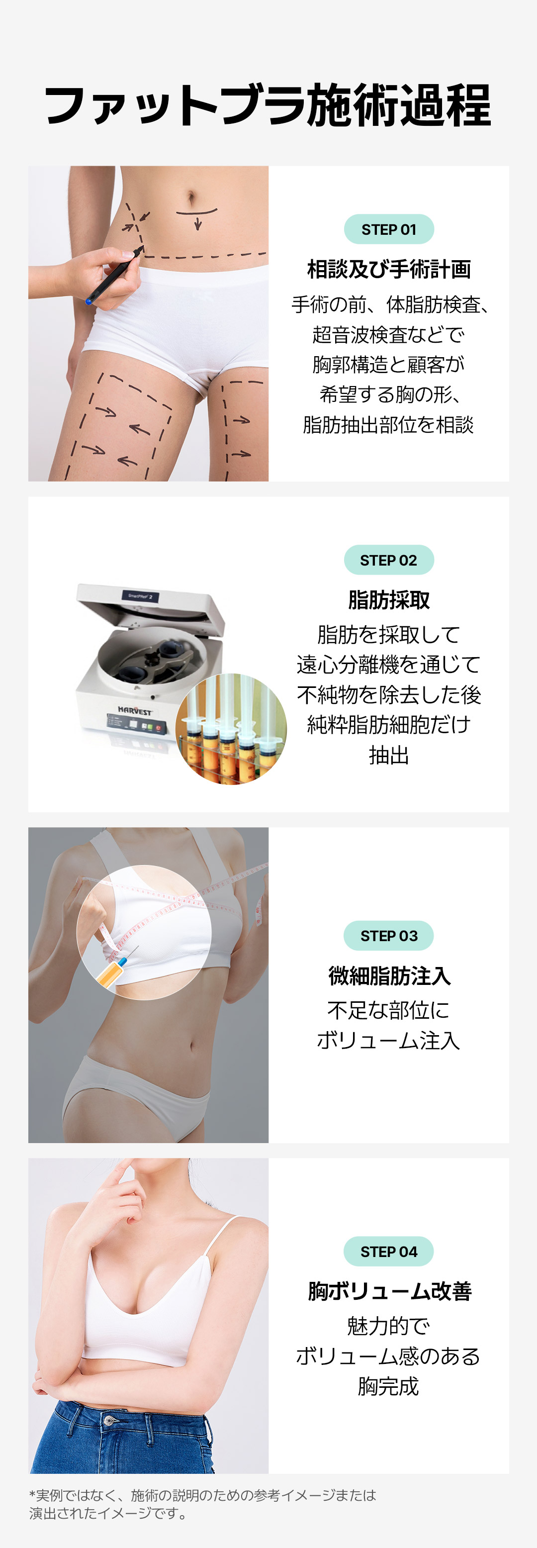 【Nâng ngực cấy mỡ】Fat Bra hướng đến nâng ngực tự nhiên | Say Yes Clinic Gangnam Hàn Quốc