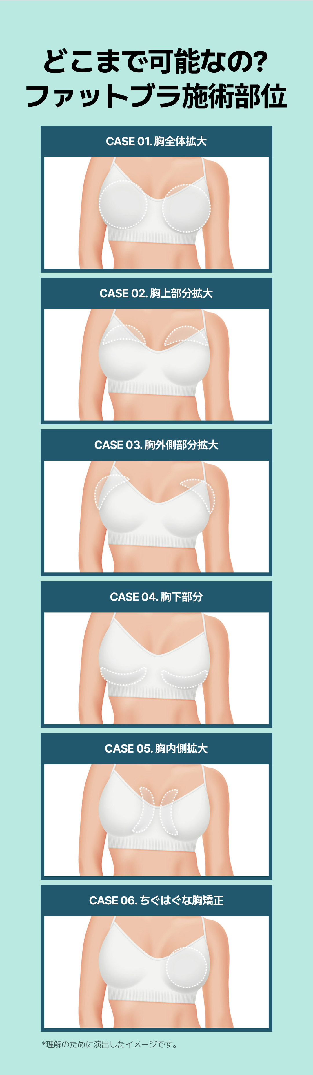 【Nâng ngực cấy mỡ】Fat Bra hướng đến nâng ngực tự nhiên | Say Yes Clinic Gangnam Hàn Quốc