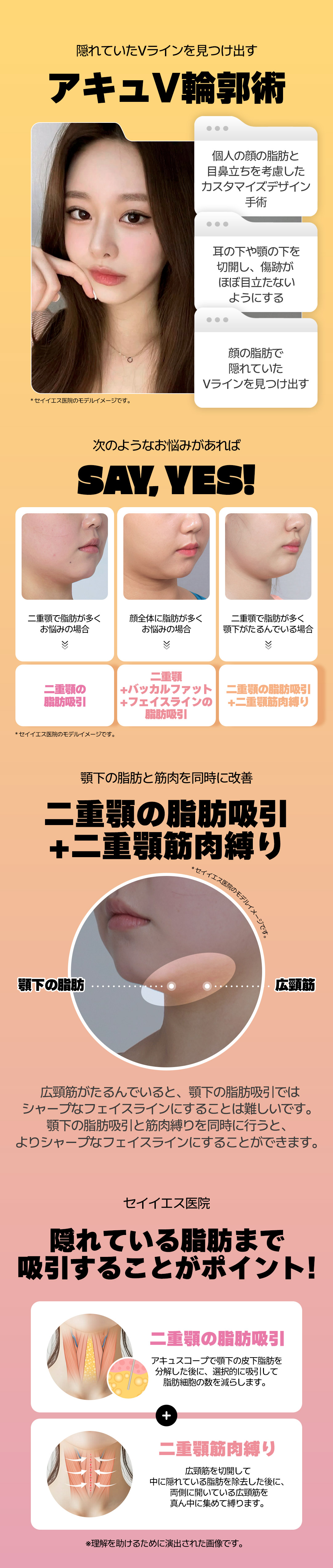 Hút mỡ mặt và phẫu thuật đường viền Accu V Say Yes Clinic Hàn Quốc | Mặt nhỏ, tạo V-line | Ga Sinnonhyeon Seoul