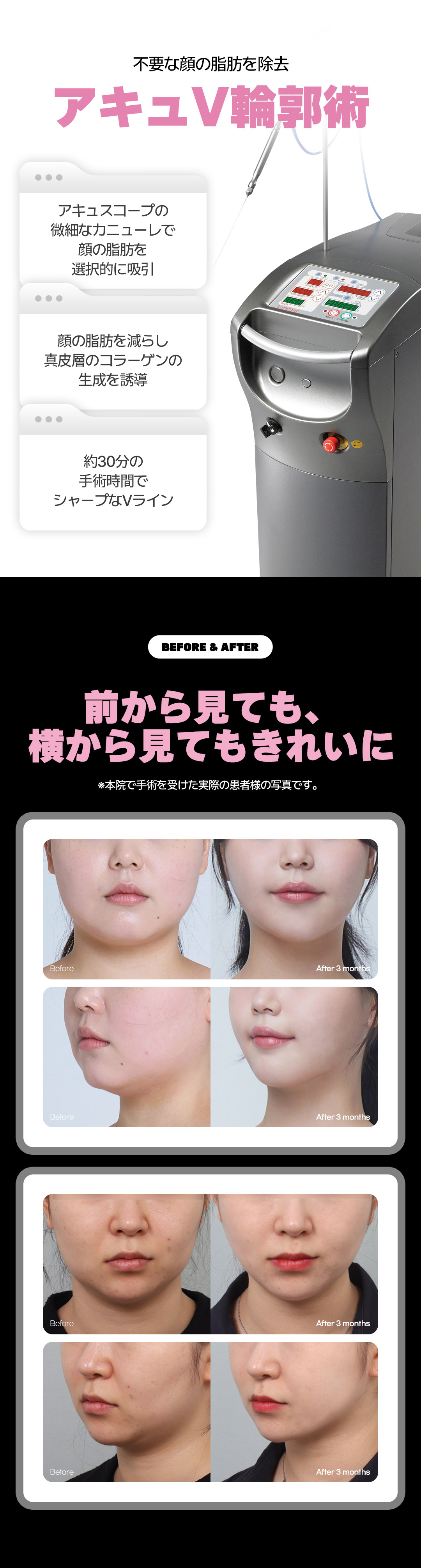 Hút mỡ mặt và phẫu thuật đường viền Accu V Say Yes Clinic Hàn Quốc | Mặt nhỏ, tạo V-line | Ga Sinnonhyeon Seoul