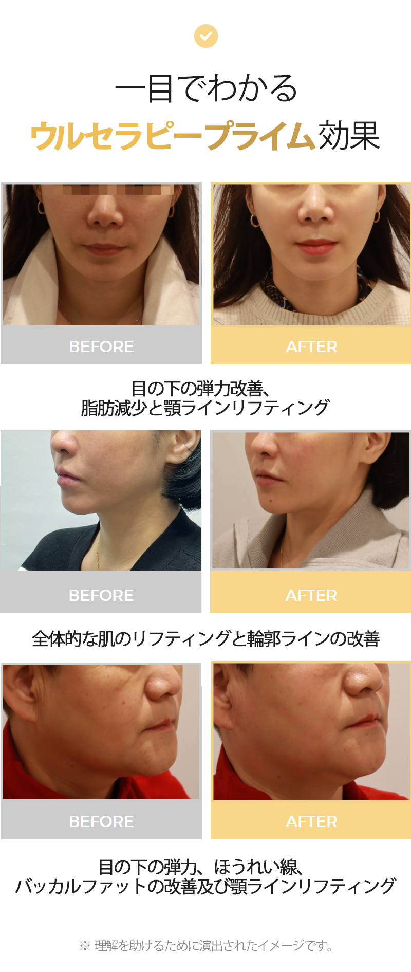 Ultherapy Prime 300 Shot｜Nâng chính xác bằng công nghệ hình ảnh siêu âm｜Phòng khám Cheongdam Dear