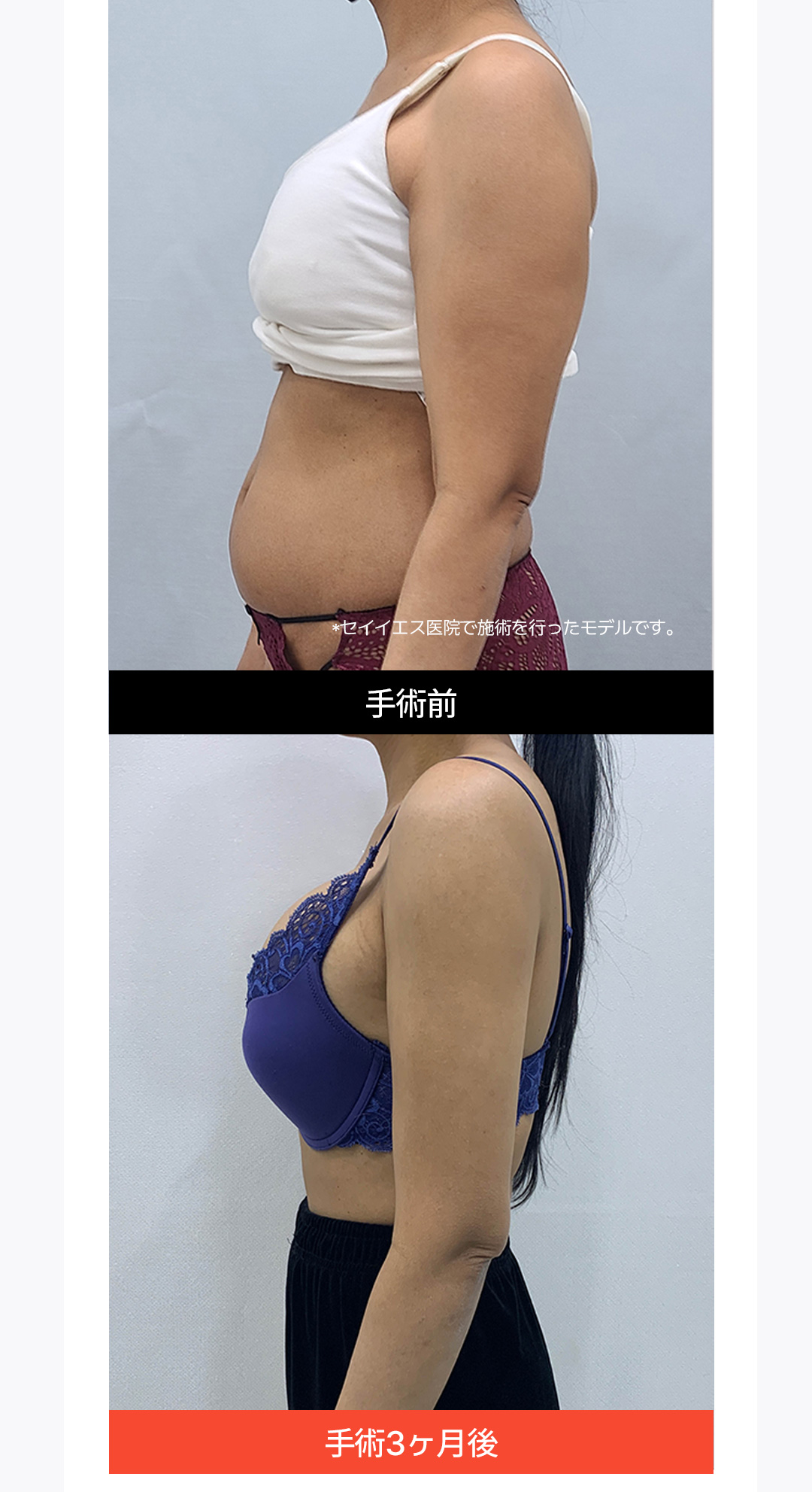 Hút mỡ toàn thân | Bác sĩ chuyên gia hơn 15 năm điều trị 3 vùng trong 1 ngày | Say Yes Gangnam Seoul