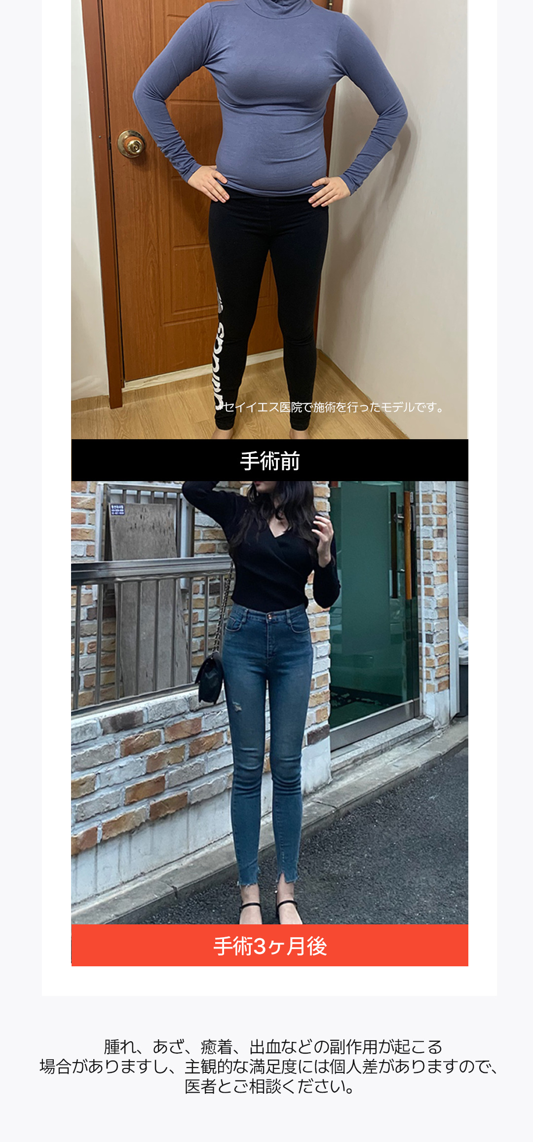 Hút mỡ toàn thân | Bác sĩ chuyên gia hơn 15 năm điều trị 3 vùng trong 1 ngày | Say Yes Gangnam Seoul