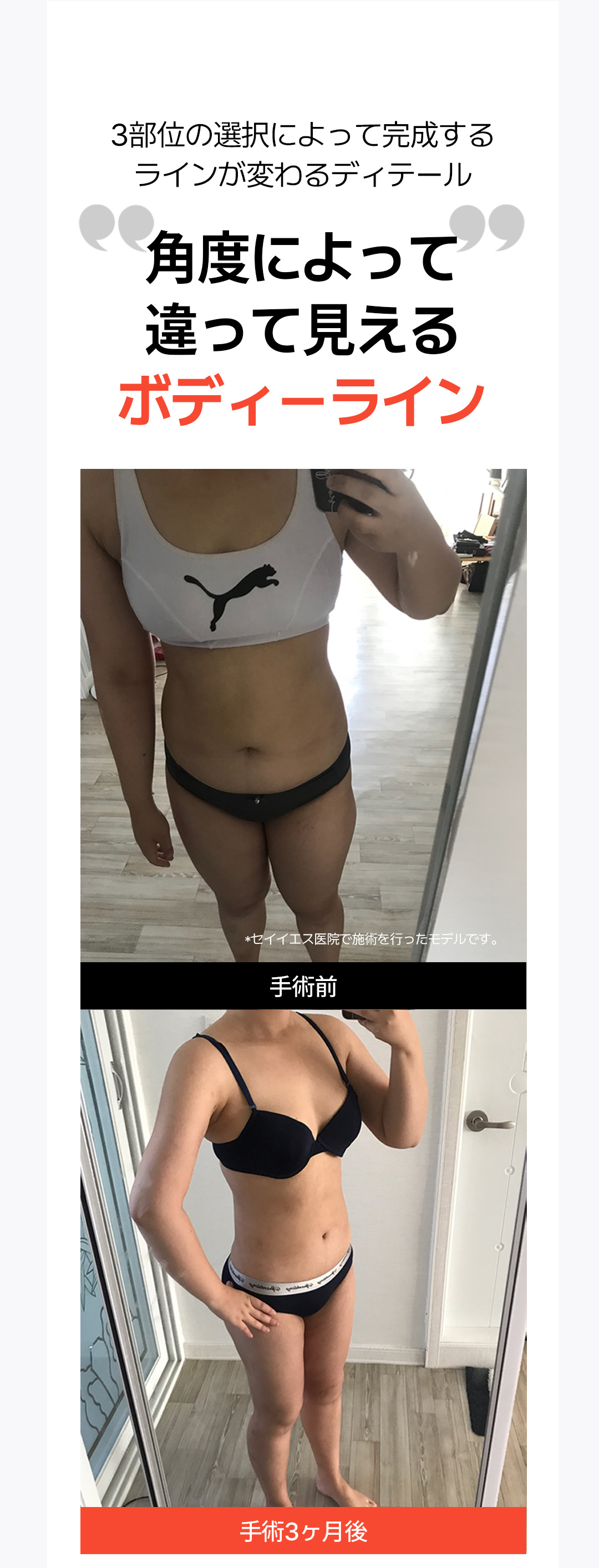 Hút mỡ toàn thân | Bác sĩ chuyên gia hơn 15 năm điều trị 3 vùng trong 1 ngày | Say Yes Gangnam Seoul