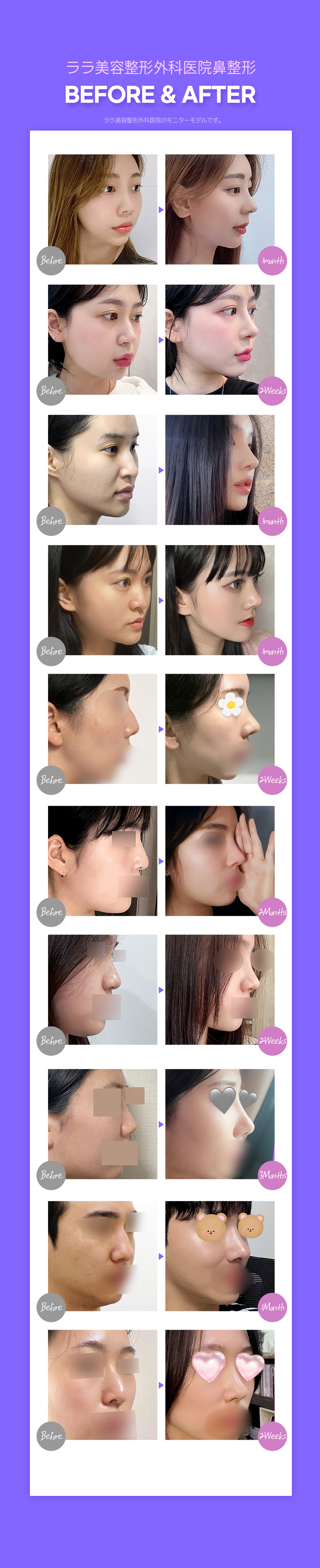 Nâng mũi tạo khuôn 3D sụn tự thân | Hướng tới kết quả tự nhiên không dùng túi độn | Lala Phẫu thuật Tạo hình Thẩm mỹ