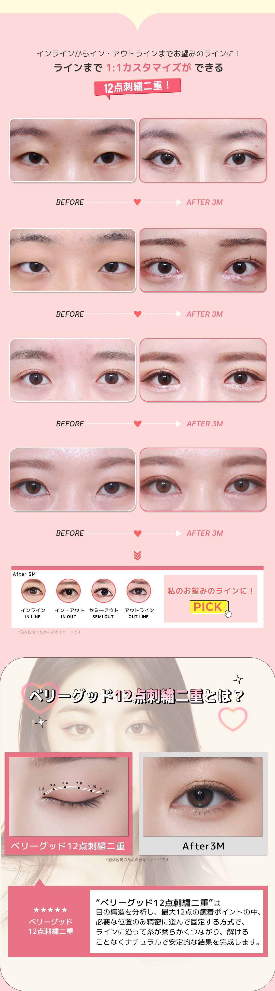 Mí đôi thêu 12 điểm của Verygood Thẩm mỹ ga Gangnam Hàn Quốc | Phương pháp bấm mí hướng tới đường nét tự nhiên với thiết kế tùy chỉnh 1:1