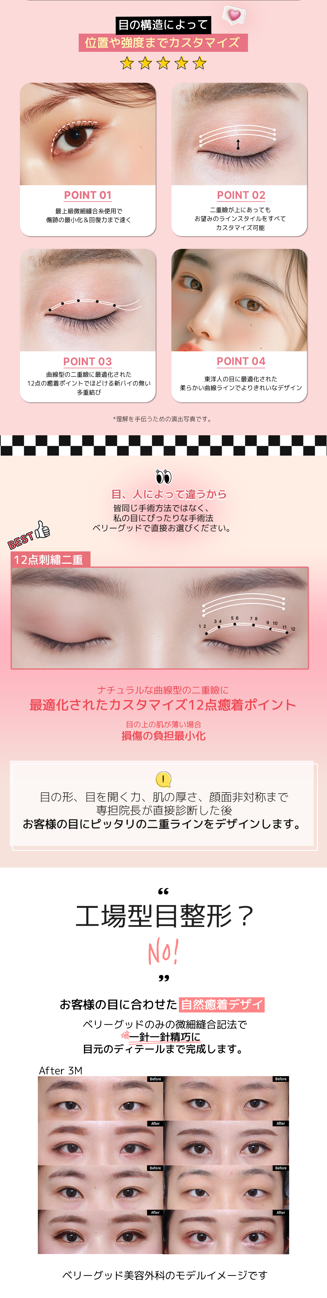 Mí đôi thêu 12 điểm của Verygood Thẩm mỹ ga Gangnam Hàn Quốc | Phương pháp bấm mí hướng tới đường nét tự nhiên với thiết kế tùy chỉnh 1:1