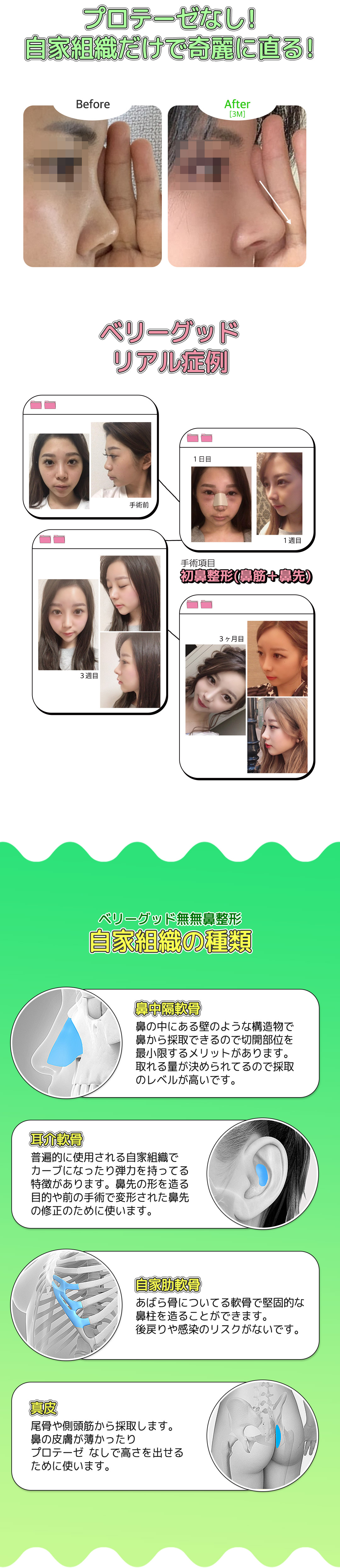 【Chỉ mô tự thân】Phẫu thuật mũi Mumu không có Verygood | Hướng tới kết quả tự nhiên không prosthesis | Verygood Thẩm mỹ ga Gangnam