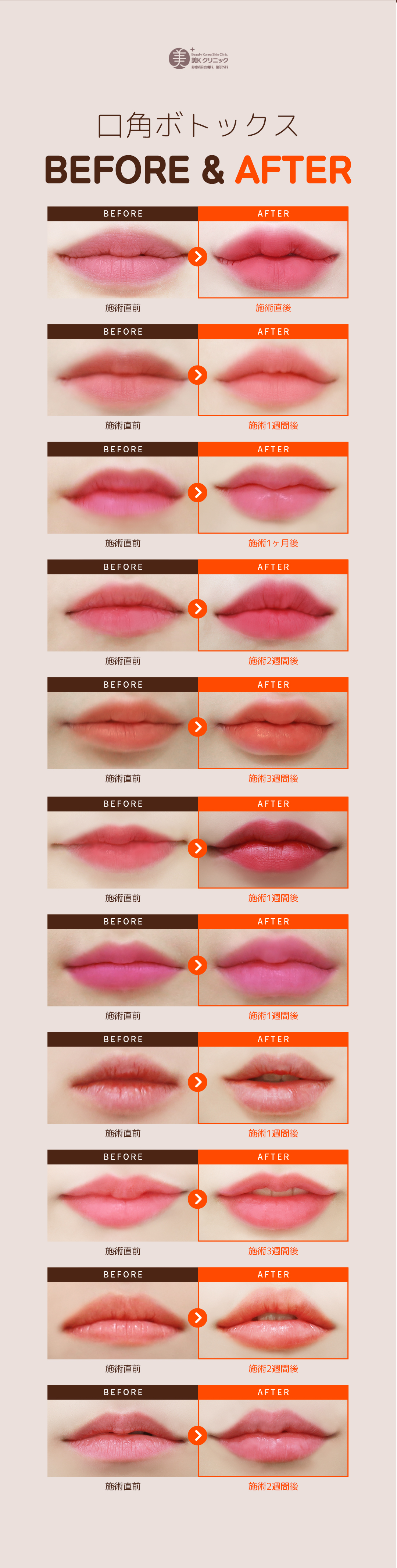 Botox khóe miệng hướng đến ấn tượng nụ cười tự nhiên｜Ga Gangnam・Phòng khám Mikei｜Khoa Da liễu Thẩm mỹ Hàn Quốc