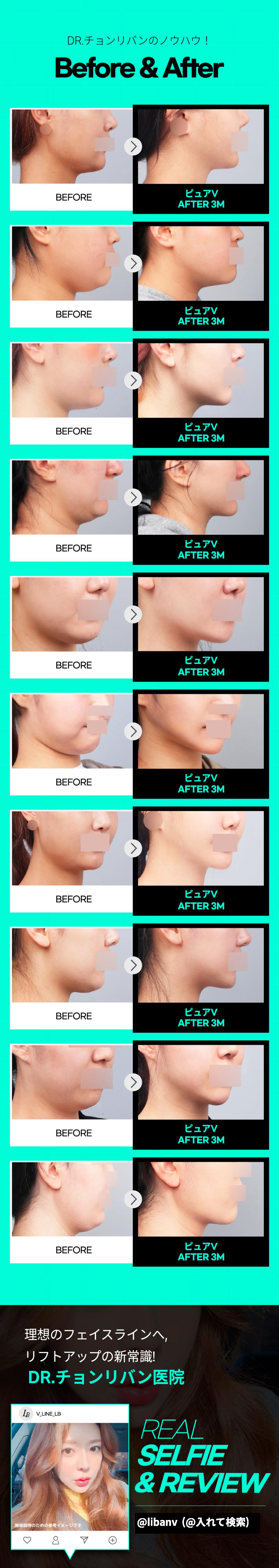 【Apgujeong】Hút mỡ mặt Pure V | Điều trị bởi bác sĩ trưởng 20 năm kinh nghiệm | Tạo V-line không cần cắt xương | Phòng khám Dr. Jeong Libang