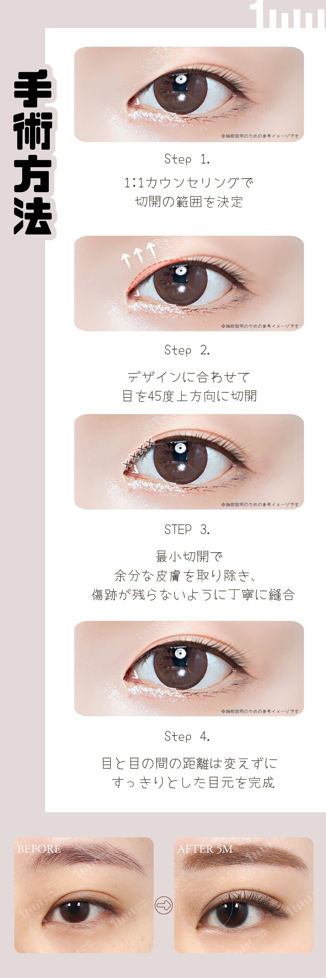 Tạo hình mắt tự nhiên với Cắt trên mắt Custom | 1mm Thẩm mỹ cách ga Gangnam 6 phút đi bộ | Thẩm mỹ Hàn Quốc