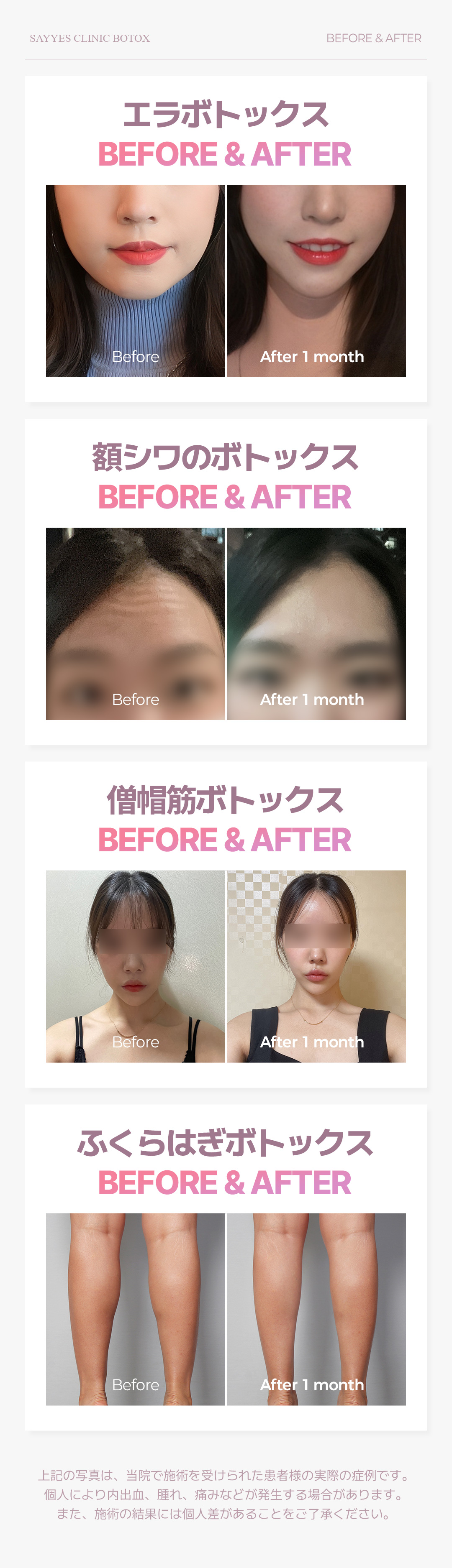 Xeomin & Coretox Botox Seoul｜Thủ thuật giảm nguy cơ kháng thuốc｜Phòng khám Say Yes