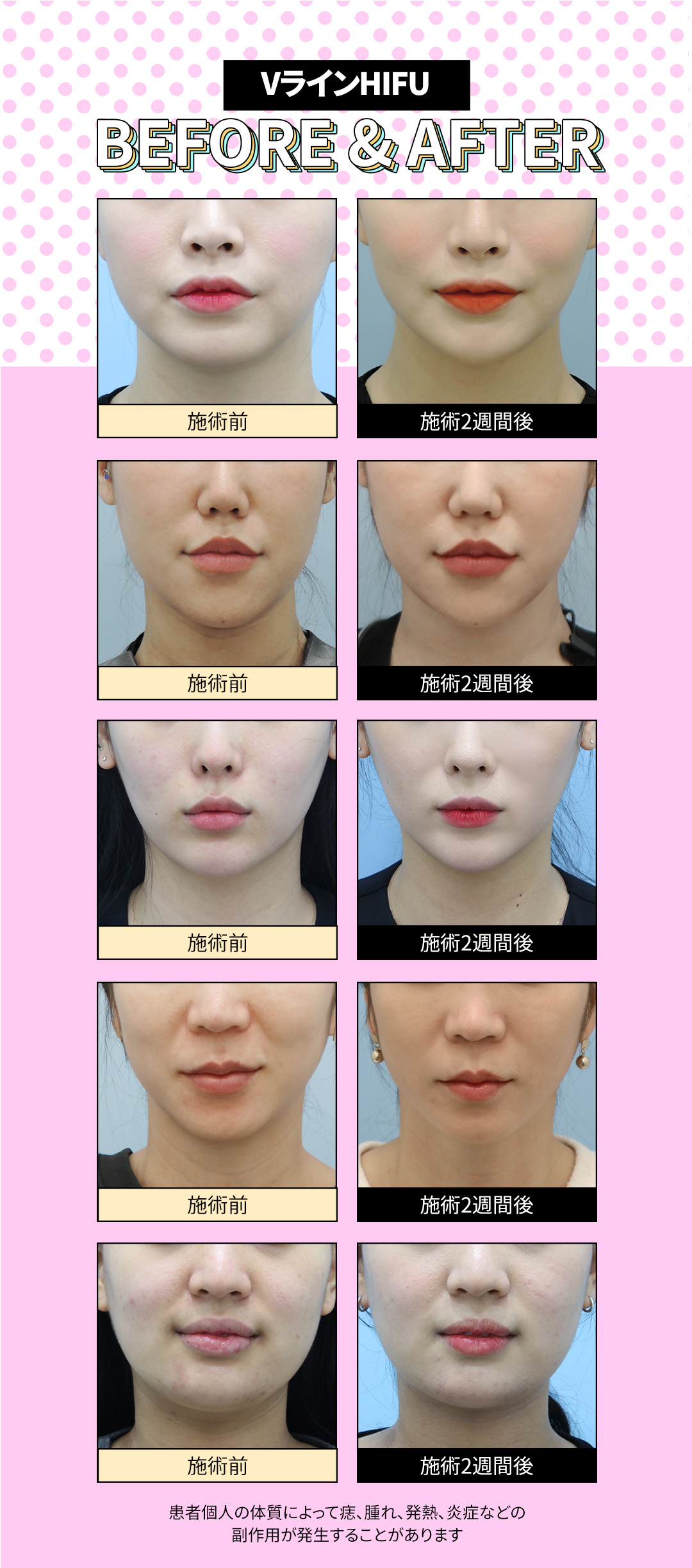 V-line HIFU mặt nhỏ Gangnam Jfeel Clinic | Đường viền mặt lý tưởng kết hợp tiêm tan mỡ [8.553 yên]