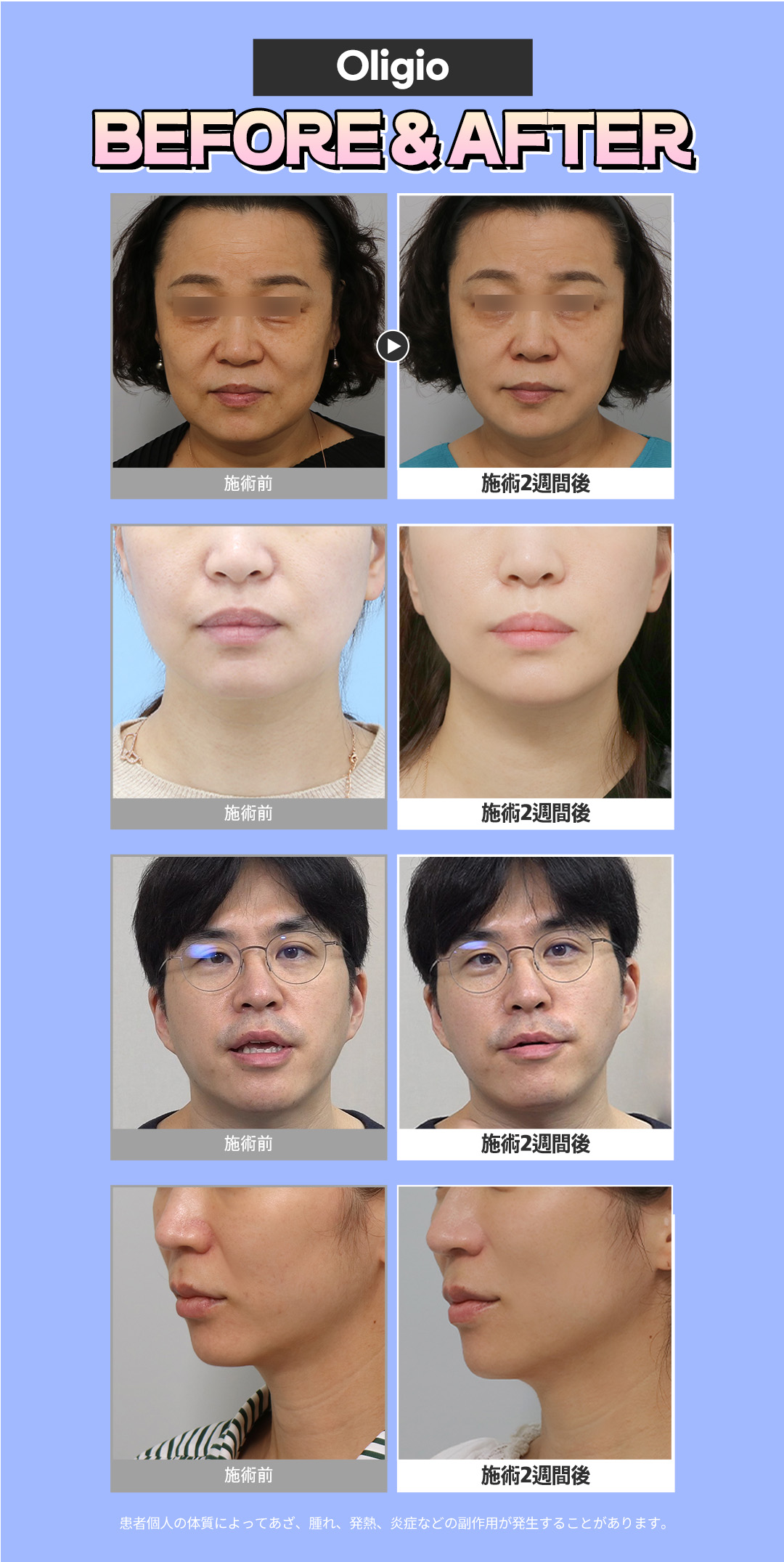 V-line HIFU mặt nhỏ Gangnam Jfeel Clinic | Đường viền mặt lý tưởng kết hợp tiêm tan mỡ [8.553 yên]