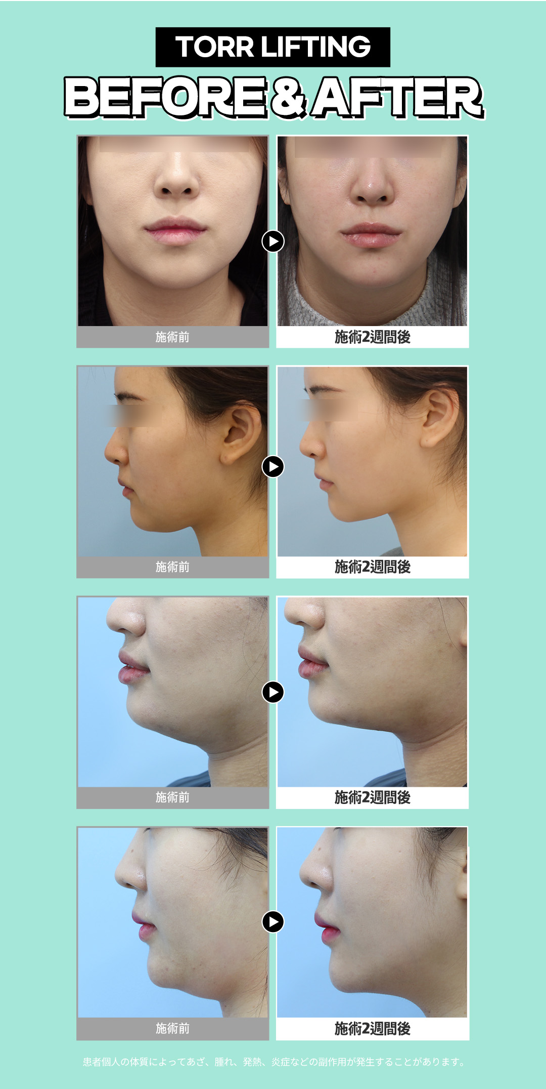 V-line HIFU mặt nhỏ Gangnam Jfeel Clinic | Đường viền mặt lý tưởng kết hợp tiêm tan mỡ [8.553 yên]