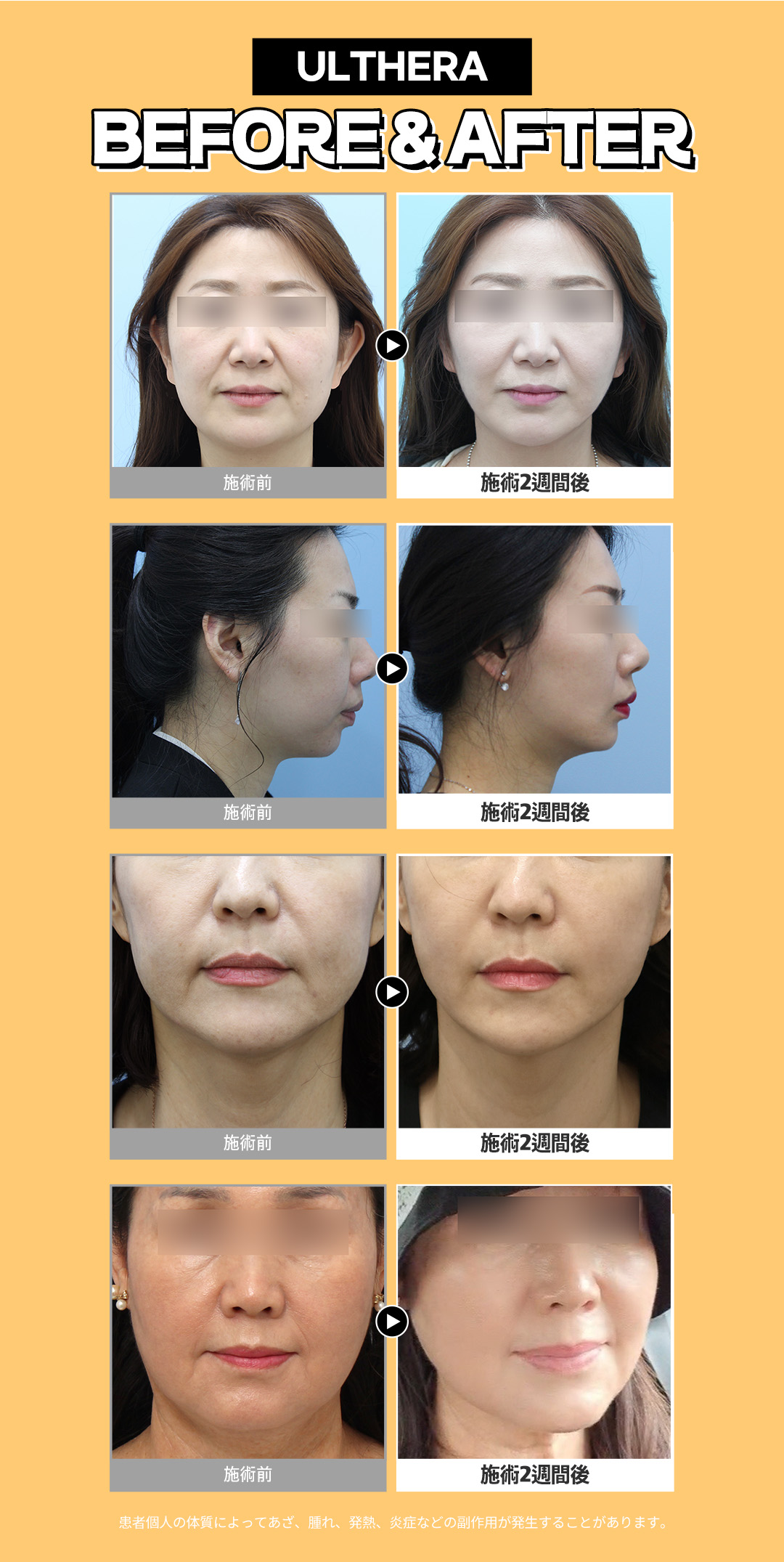 V-line HIFU mặt nhỏ Gangnam Jfeel Clinic | Đường viền mặt lý tưởng kết hợp tiêm tan mỡ [8.553 yên]