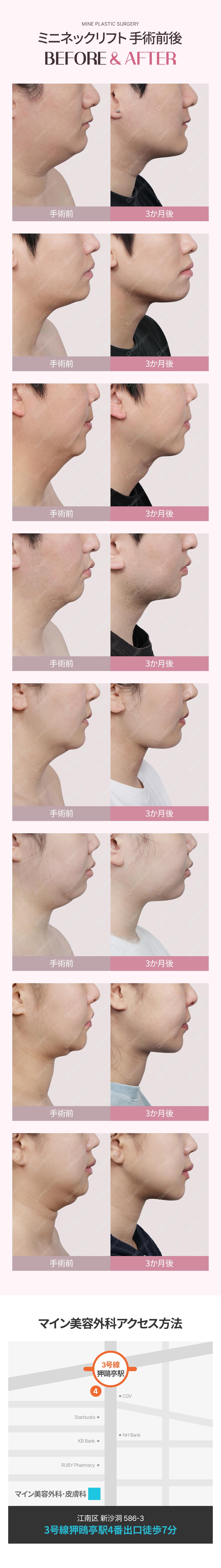 Mini Neck Lift | Liệu trình rạch hướng đến cải thiện chảy xệ cổ và nọng cằm | Mine Thẩm mỹ Ngoại khoa【Apgujeong】