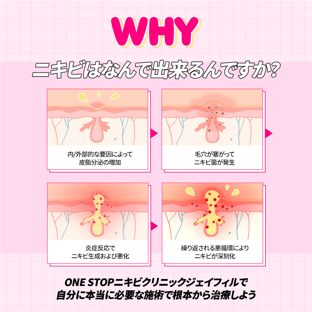 Chuyên điều trị mụn・chăm sóc theo đơn đặt hàng theo nguyên nhân | Agnes laser・PDT・peel | Seoul Gangnam stn.・Phòng khám Jfeel chi nhánh Gangnam