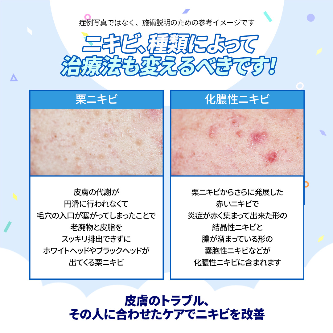 Chuyên điều trị mụn・chăm sóc theo đơn đặt hàng theo nguyên nhân | Agnes laser・PDT・peel | Seoul Gangnam stn.・Phòng khám Jfeel chi nhánh Gangnam