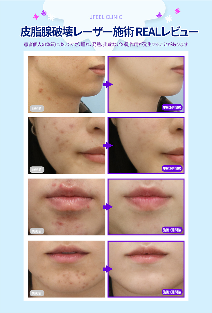 Chuyên điều trị mụn・chăm sóc theo đơn đặt hàng theo nguyên nhân | Agnes laser・PDT・peel | Seoul Gangnam stn.・Phòng khám Jfeel chi nhánh Gangnam