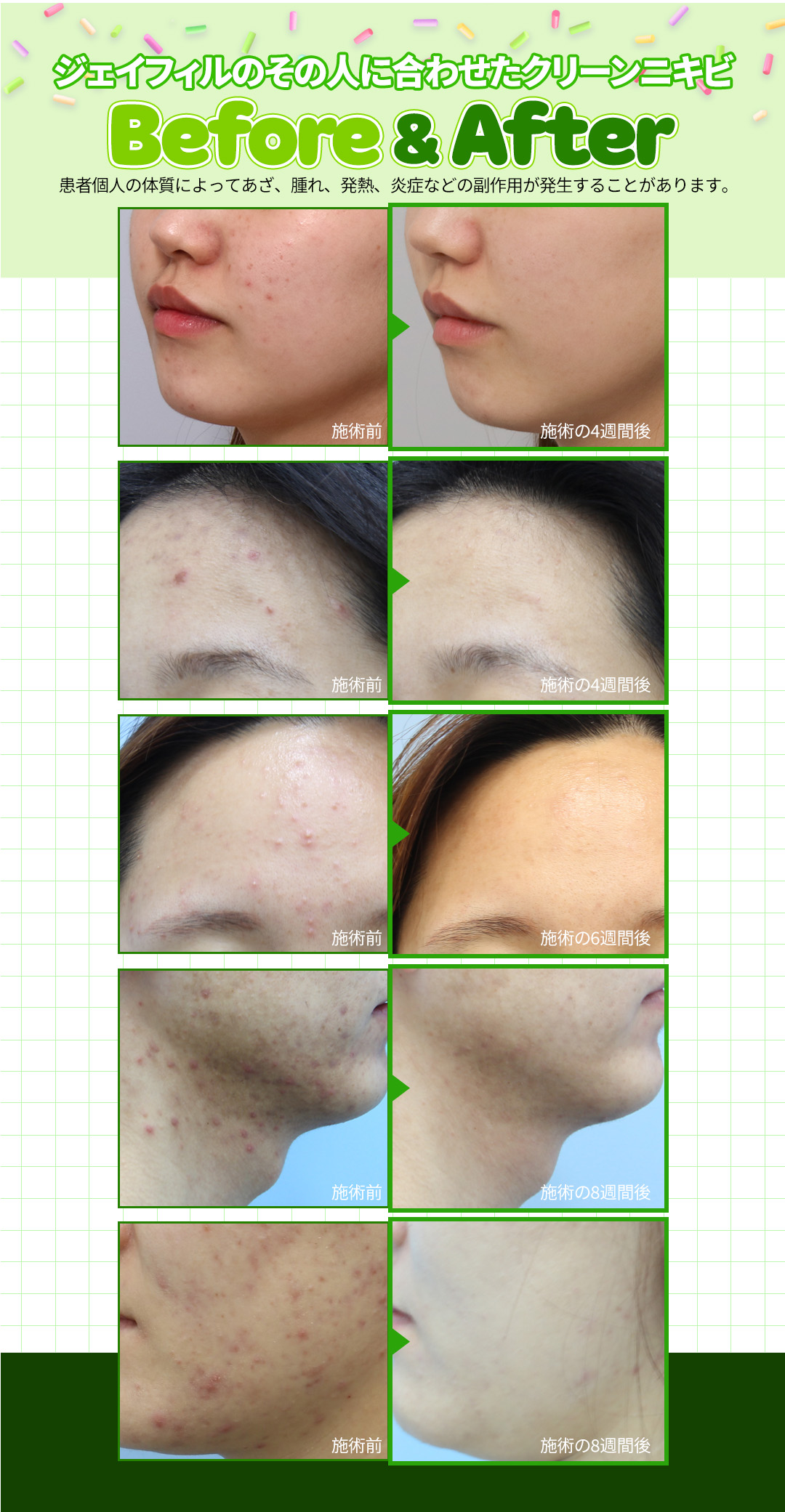 Chuyên điều trị mụn・chăm sóc theo đơn đặt hàng theo nguyên nhân | Agnes laser・PDT・peel | Seoul Gangnam stn.・Phòng khám Jfeel chi nhánh Gangnam